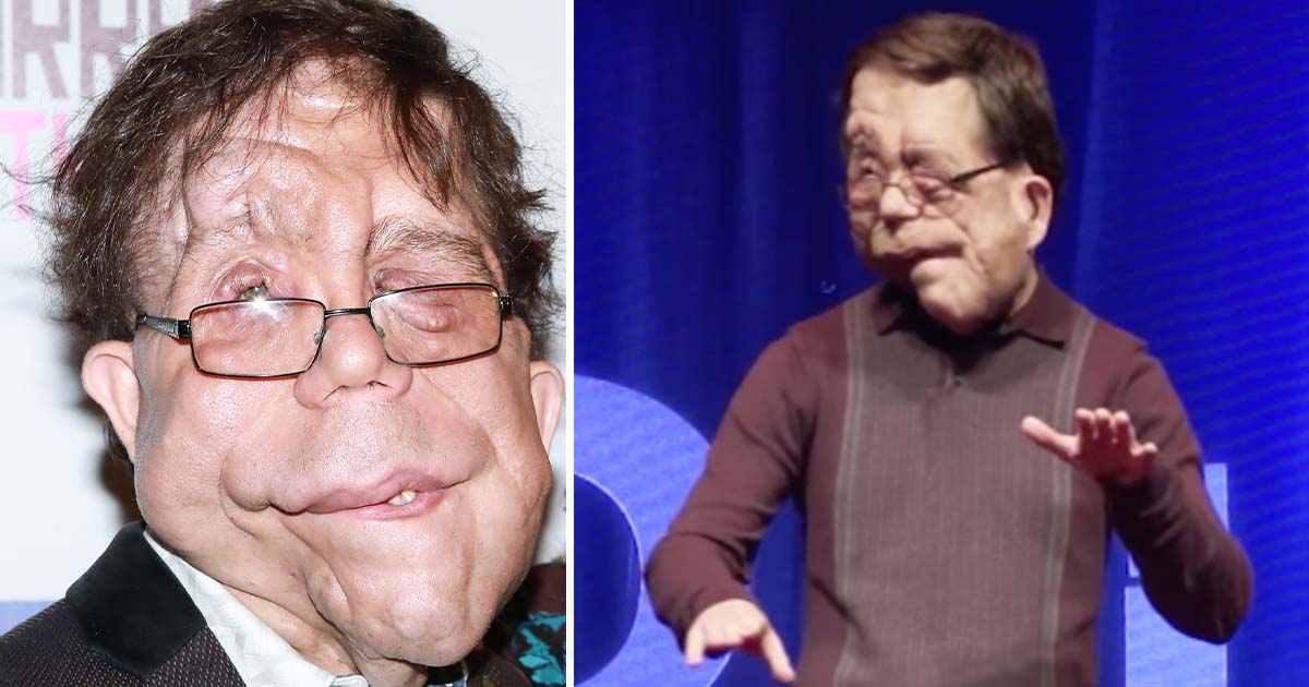 The extraordinary life of actor Adam Pearson He serves as an